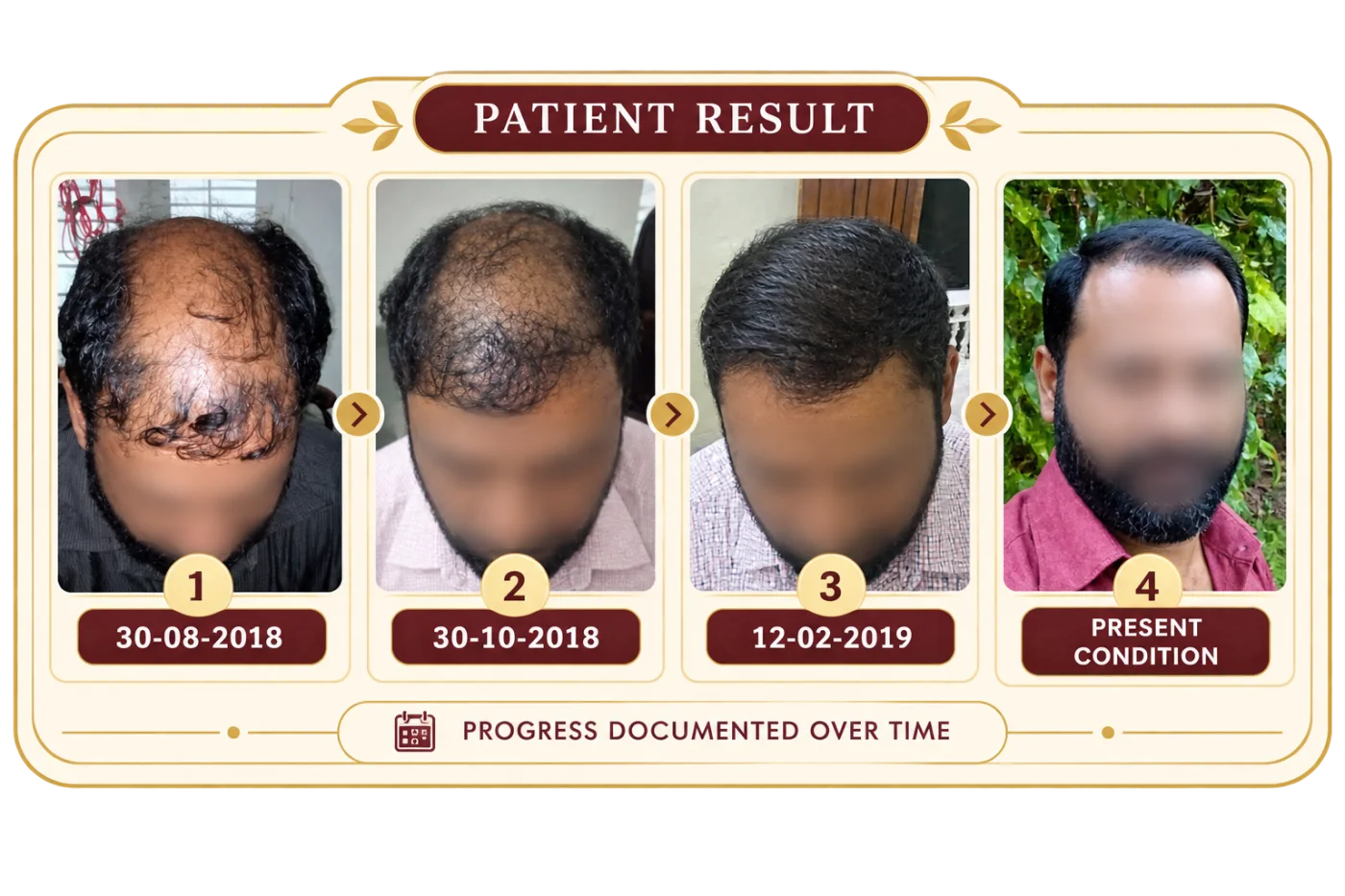 Patient hair progress before and after