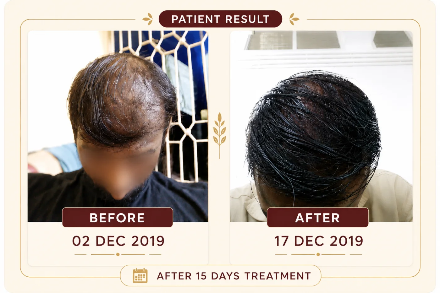 Patient hair progress before and after