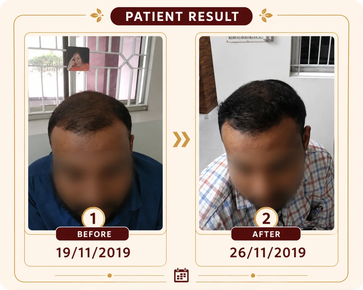 Hair and scalp progress documented during treatment